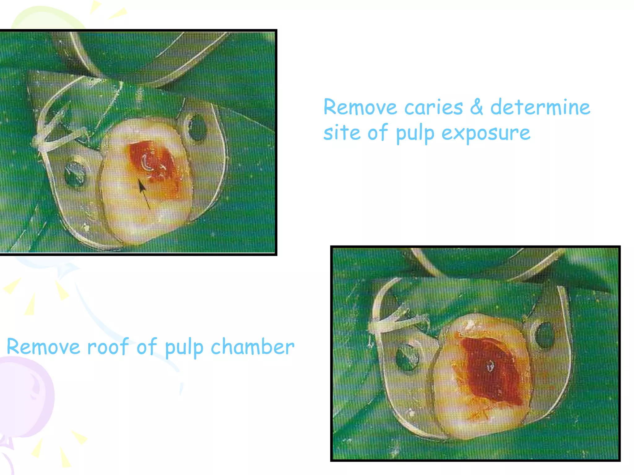 Remove caries & determine site of pulp exposure Remove roof of pulp chamber   