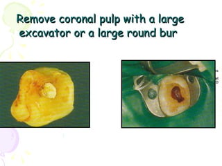Remove coronal pulp with a large excavator or a large round bur   