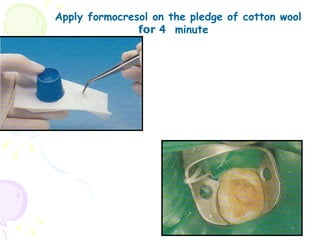 Apply formocresol on the pledge of cotton wool for   4  minute 