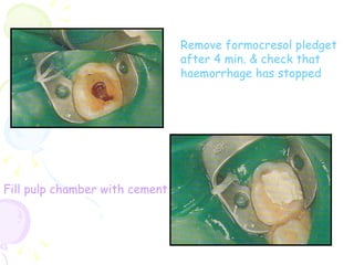 Remove formocresol pledget after 4 min. & check that haemorrhage has stopped Fill pulp chamber with cement 