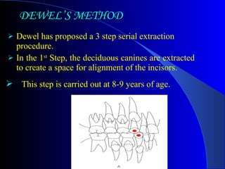 DEWEL’S METHOD Dewel has proposed a 3 step serial extraction  procedure.  In the 1 st  Step, the deciduous canines are extracted to create a space for alignment of the incisors.  This step is carried out at 8-9 years of age. 