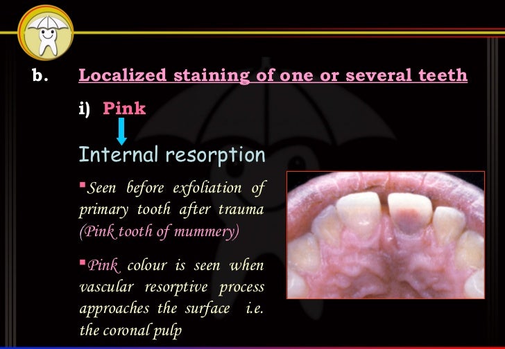 Tooth Discolouration Pedo