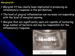 Marginal Opening 32338285 effects-of-restorative-procedure-on-um-perio | PPT