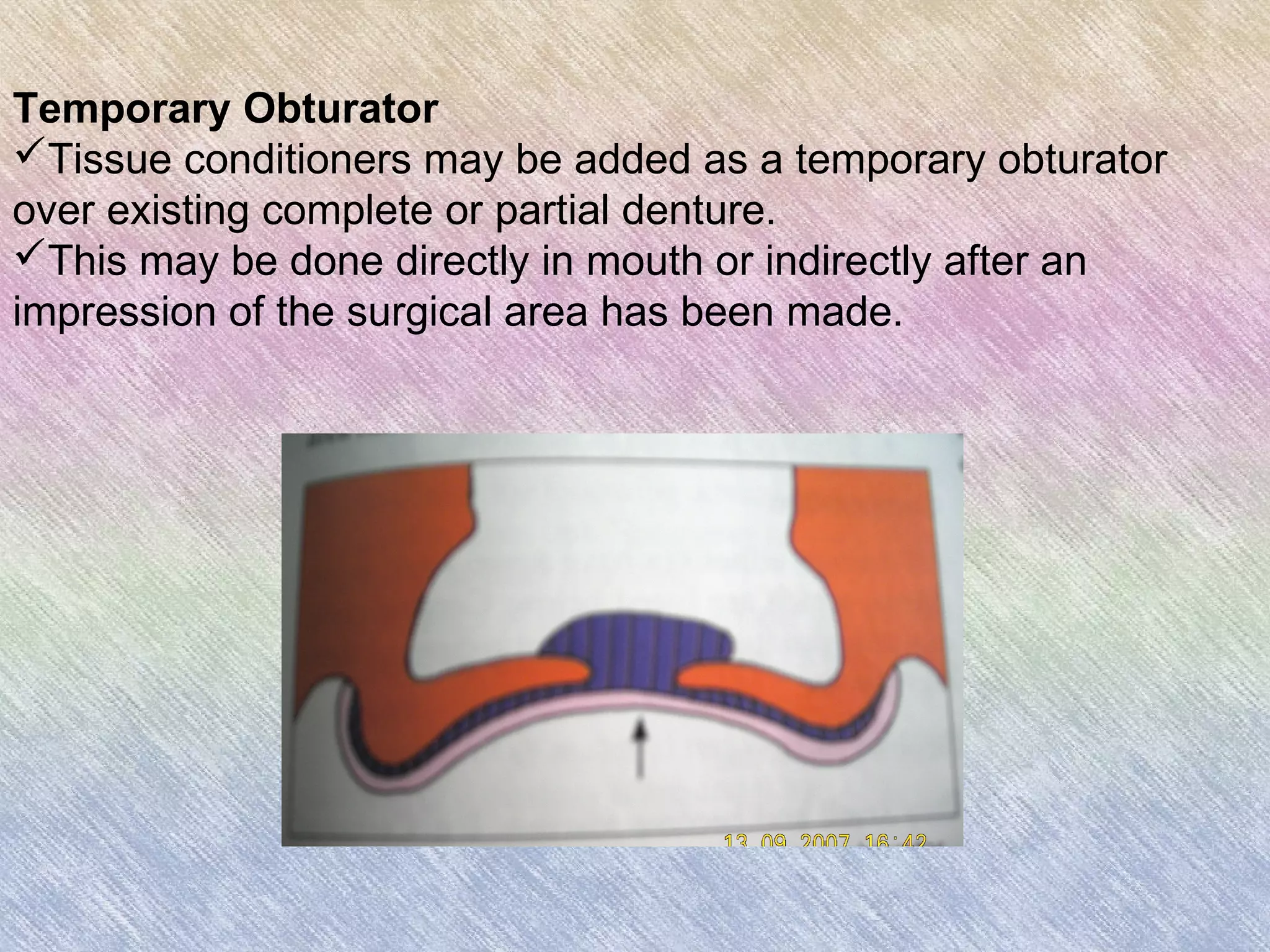 Temporary Obturator
Tissue conditioners may be added as a temporary obturator
over existing complete or partial denture.
This may be done directly in mouth or indirectly after an
impression of the surgical area has been made.
 