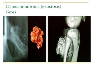 Exostis Bone Tumours presentation benign malignant.ppt