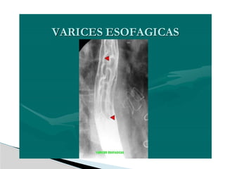 ESOFAGOGRAMA estudio radiologico contrastado | PPTX