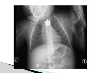 ESOFAGOGRAMA estudio radiologico contrastado | PPTX