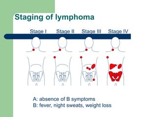 Stage I Stage II Stage III Stage IV
Staging of lymphoma
A: absence of B symptoms
B: fever, night sweats, weight loss
 