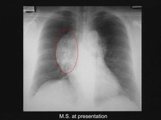 M.S. at presentation
 