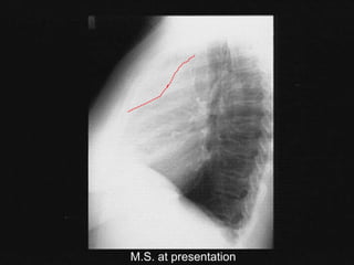 M.S. at presentation
 