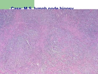 Case: M.S. lymph node biopsy
 