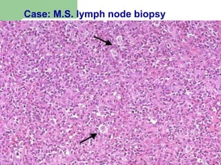Case: M.S. lymph node biopsy
 