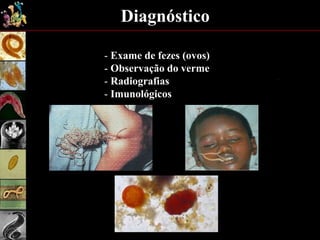 - Exame de fezes (ovos)
- Observação do verme
- Radiografias
- Imunológicos
Diagnóstico
 