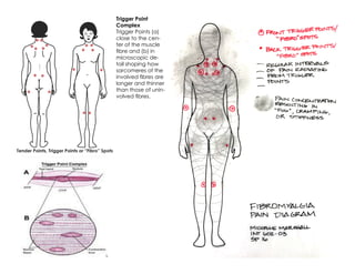 Trigger Point
Complex
Trigger Points (a)
close to the cen-
ter of the muscle
fibre and (b) in
microscopic de-
tail shoping how
sarcomeres of the
involved fibres are
longer and thinner
than those of unin-
volved fibres.
Tender Points, Trigger Points or “Fibro” Spots
 