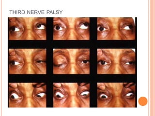 THIRD NERVE PALSY
 
