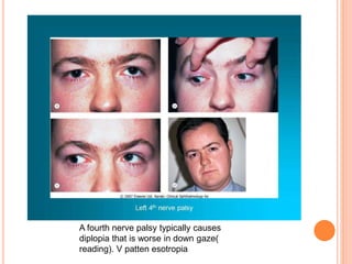 A fourth nerve palsy typically causes
diplopia that is worse in down gaze(
reading). V patten esotropia
 