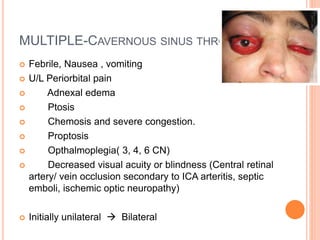 MULTIPLE-CAVERNOUS SINUS THROMBOSIS
 Febrile, Nausea , vomiting
 U/L Periorbital pain
 Adnexal edema
 Ptosis
 Chemosis and severe congestion.
 Proptosis
 Opthalmoplegia( 3, 4, 6 CN)
 Decreased visual acuity or blindness (Central retinal
artery/ vein occlusion secondary to ICA arteritis, septic
emboli, ischemic optic neuropathy)
 Initially unilateral  Bilateral
 