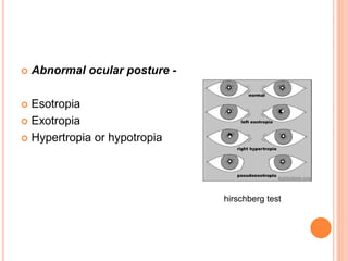  Abnormal ocular posture -
 Esotropia
 Exotropia
 Hypertropia or hypotropia
hirschberg test
 