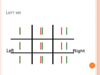 LEFT MR
 