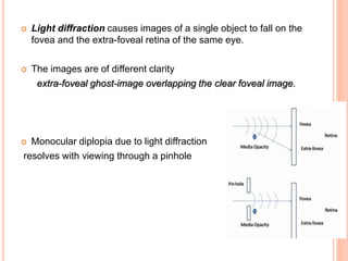  Light diffraction causes images of a single object to fall on the
fovea and the extra-foveal retina of the same eye.
 The images are of different clarity
extra-foveal ghost-image overlapping the clear foveal image.
 Monocular diplopia due to light diffraction
resolves with viewing through a pinhole
 