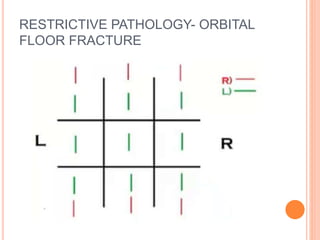 RESTRICTIVE PATHOLOGY- ORBITAL
FLOOR FRACTURE
 
