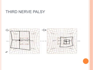 THIRD NERVE PALSY
 