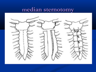 chest trauma management | PPT
