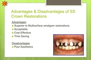 Advantages & Disadvantages of SS
Crown Restorations
Advantages:
 Superior to Multisurface amalgam restorations
 Acceptable
 Cost Effective
 Time Saving
Disadvantages:
 Poor Aesthetics
 
