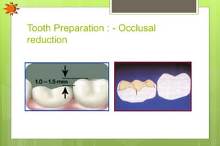 Tooth Preparation : - Occlusal
reduction
 