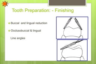 Tooth Preparation: - Finishing
 Buccal and lingual reduction
 Occlusobuccal & lingual
Line angles
 