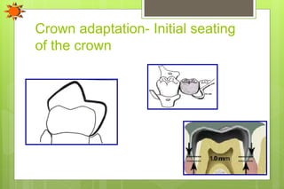 Crown adaptation- Initial seating
of the crown
 