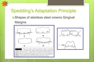 Spedding’s Adaptation Principle
Shapes of stainless steel crowns Gingival
Margins
 