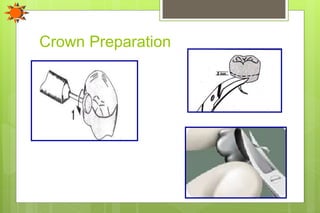 Crown Preparation
 