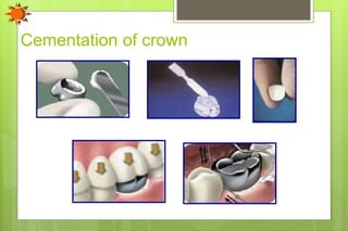Cementation of crown
 