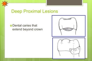 Deep Proximal Lesions
Dental caries that
extend beyond crown
 