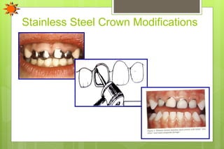 Stainless Steel Crown Modifications
 