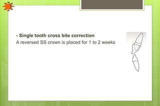 - Single tooth cross bite correction
A reversed SS crown is placed for 1 to 2 weeks
 