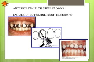 ANTERIOR STAINLESS STEEL CROWNS
FACIAL CUT OUT STAINLESS STEEL CROWNS
 
