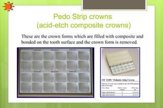 Pedo Strip crowns
(acid-etch composite crowns)
These are the crown forms which are filled with composite and
bonded on the tooth surface and the crown form is removed.
 