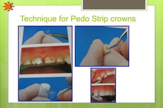 Technique for Pedo Strip crowns
 