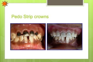 Pedo Strip crowns
 
