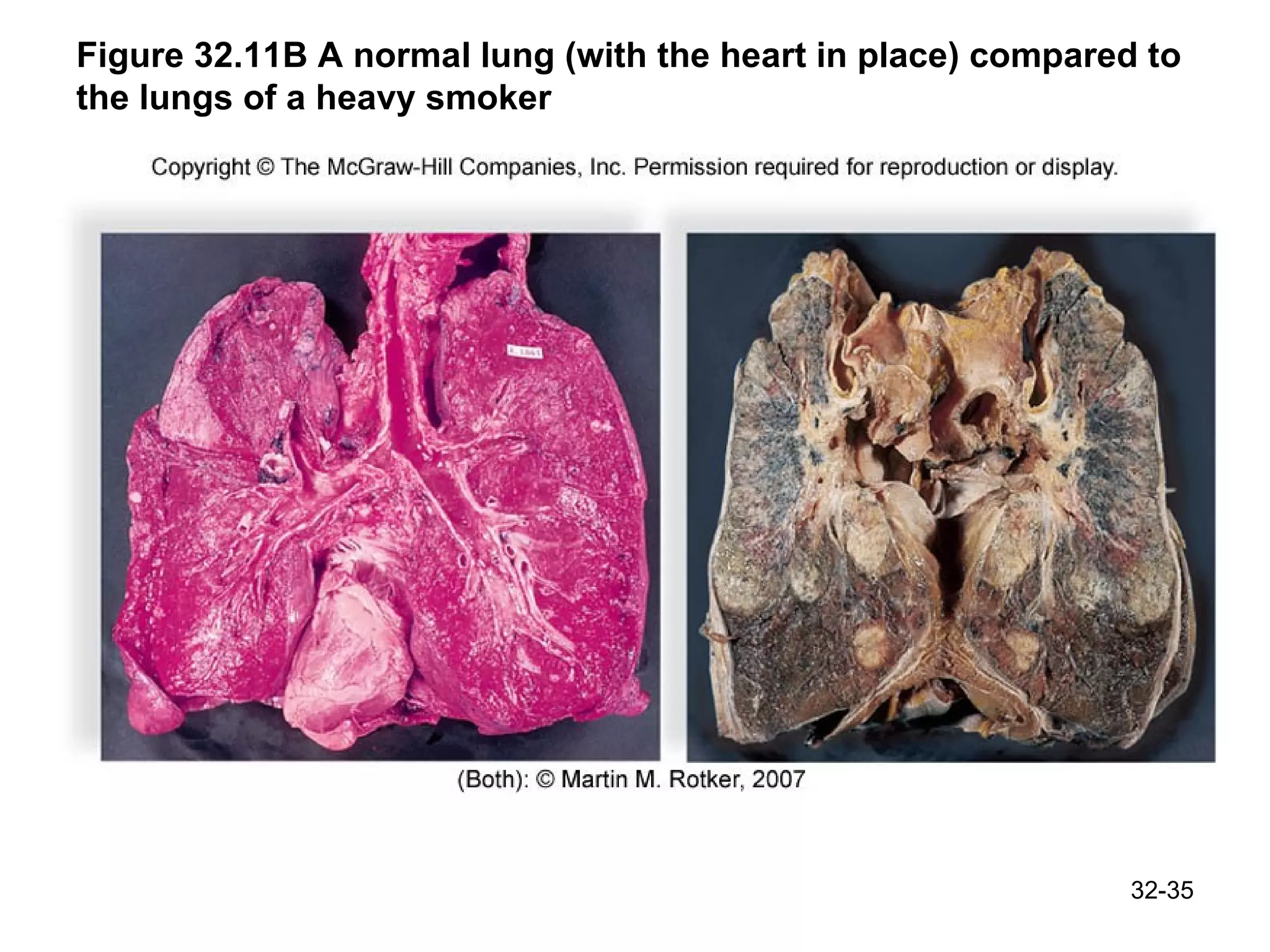 Figure 32.11B A normal lung (with the heart in place) compared to the lungs of a heavy smoker 32- 