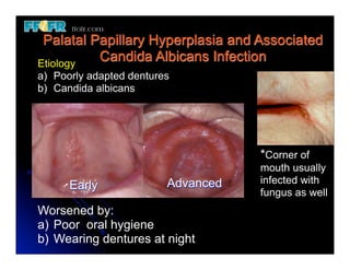 Palatal Infection 32(new).preprosthetic surgical procedures (n) | PDF