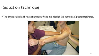 Reduction technique
The arm is pulled and rotated laterally, while the head of the humerus is pushed forwards.
21
 