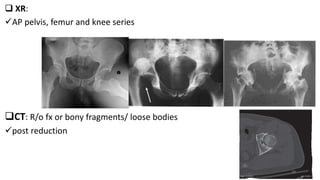  XR:
AP pelvis, femur and knee series
CT: R/o fx or bony fragments/ loose bodies
post reduction
38
 