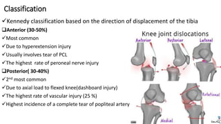 Classification
Kennedy classification based on the direction of displacement of the tibia
Anterior (30-50%)
Most common
Due to hyperextension injury
Usually involves tear of PCL
The highest rate of peroneal nerve injury
Posterior( 30-40%)
2nd most common
Due to axial load to flexed knee(dashboard injury)
The highest rate of vascular injury (25 %)
Highest incidence of a complete tear of popliteal artery
50
 
