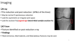 Imaging
X-ray
Pre-reduction and post reduction (AP&Lt of the Knee)
 May be normal if spontaneous reduction
 Look for asymmetric or irregular joint space
 Look for avulsion Fxs(segond sign-lateral tibial condyle avulsion Fx)
CT Scan
Facture identified on post reduction x-ray
Findings
 Tibial eminence, tibial tubercle, and tibial plateau fractures may be seen
52
 