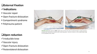 External Fixation
Indications
 Vascular repair
 Open fracture-dislocation
 Compartment syndrome
 Polytrauma patient
Open reduction
Irreducible knee
Vascular injury
Open fracture-dislocation
Posterolateral dislocation
55
 