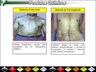 Industria de Borracha 
Vitiligo Ocupacional causado pelo 
monobentil éter de hidroquinona 
(MBEH). 
Industria da Galvanoplastia 
Dermatite alérgica de contato em 
pedreiro polissensiblizado a cromato, 
aceleradores de borracha e tópicos 
(sulfa, furacin e prometazina). 
 