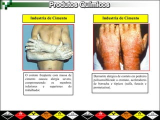 Industria de Cimento Industria de Cimento 
O contato freqüente com massa de 
cimento causou alergia severa, 
comprometendo os membros 
inferiores e superiores do 
trabalhador. 
Dermatite alérgica de contato em pedreiro 
polissensiblizado a cromato, aceleradores 
de borracha e tópicos (sulfa, furacin e 
prometazina). 
 